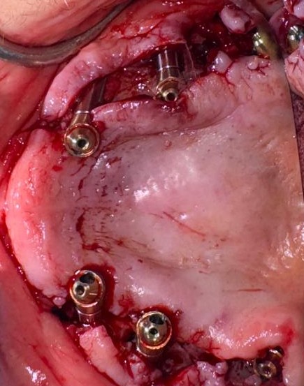 Intraoral surgical placement of zygomatic and pterygoid implants for remote anchorage